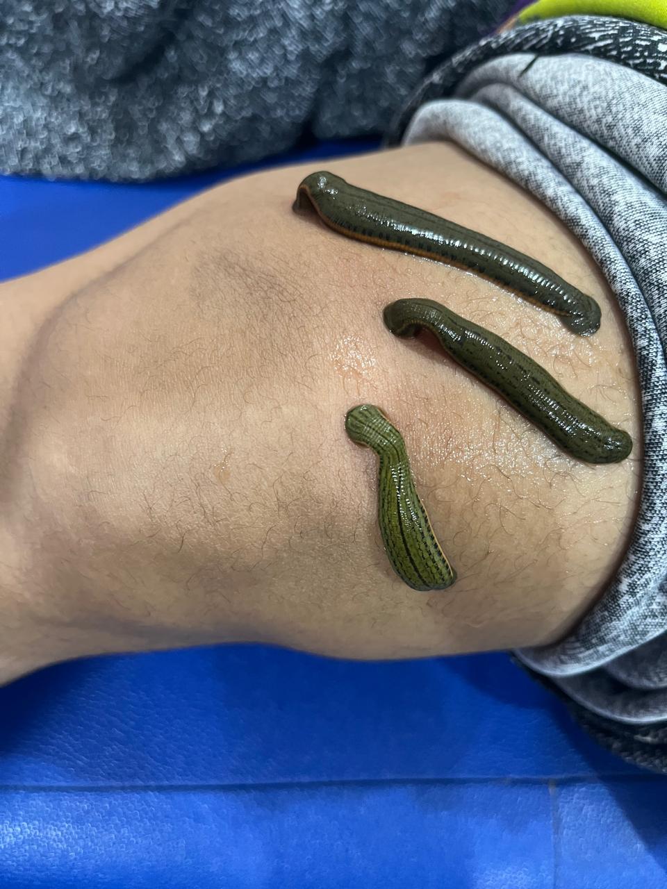 Leech therapy being performed around a patient's knee