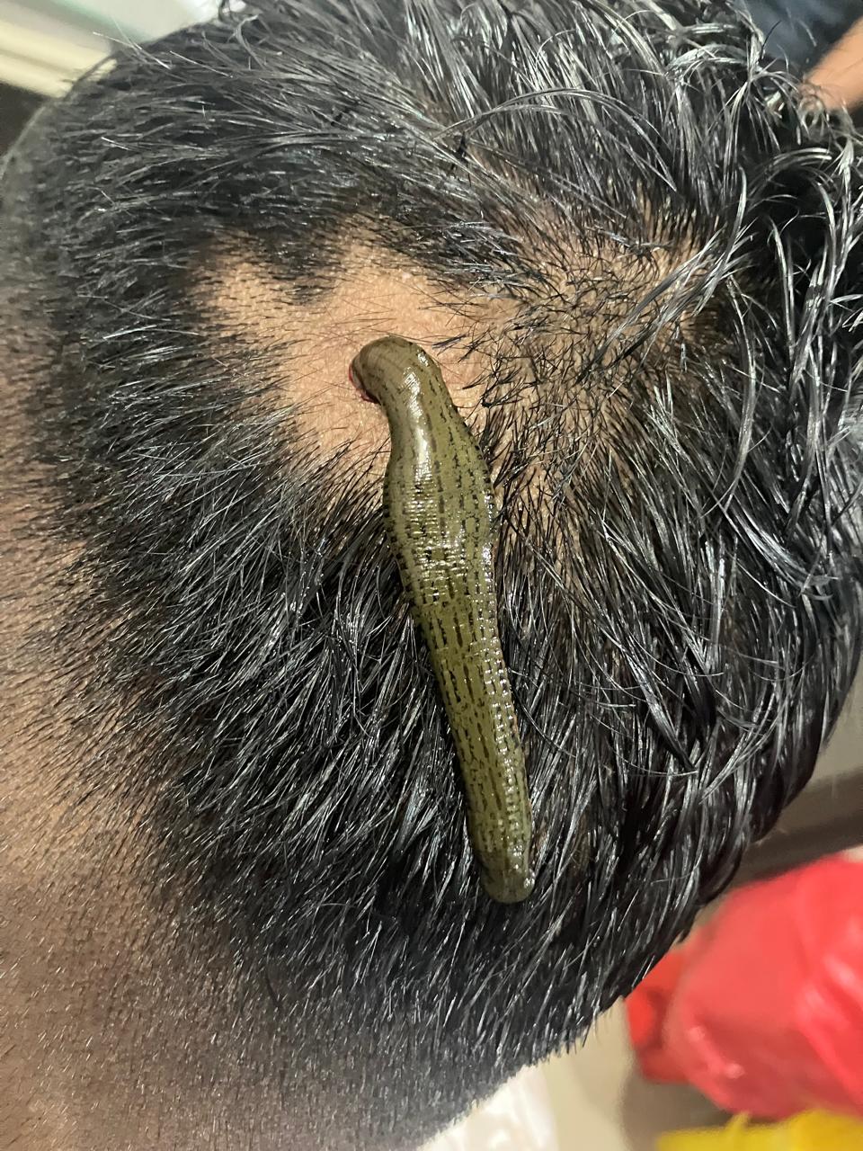 A leech used during a scalp treatment procedure